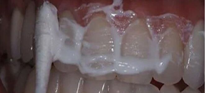 Жена стоматолога научила меня устранять зубной камень и отбеливать зубы за 4 минуты